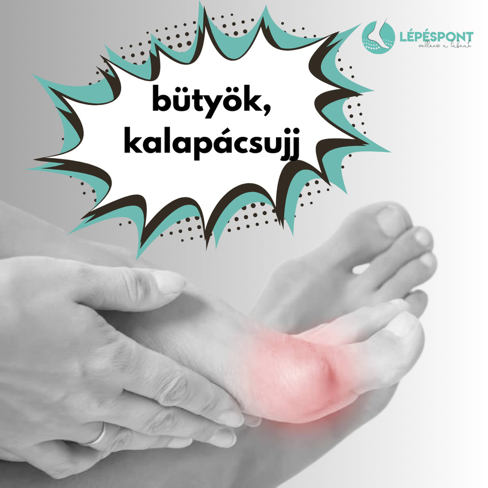 Mi az a bütyök? Cipőválasztási tanácsok érthetően